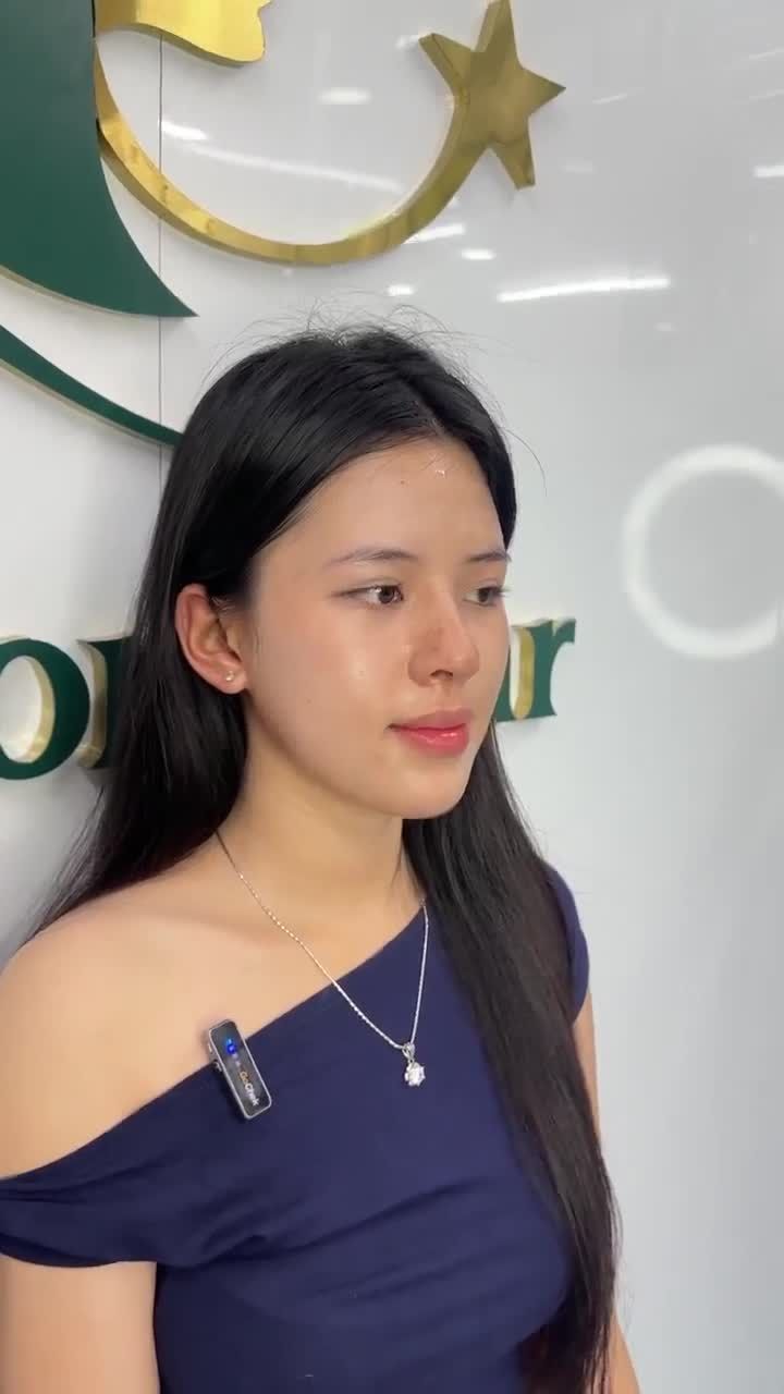LỘT XÁC DIỆN MẠO CHỈ SAU 10 NGÀY NÂNG MŨI CẤU TRÚC SỤN SURGIFORM