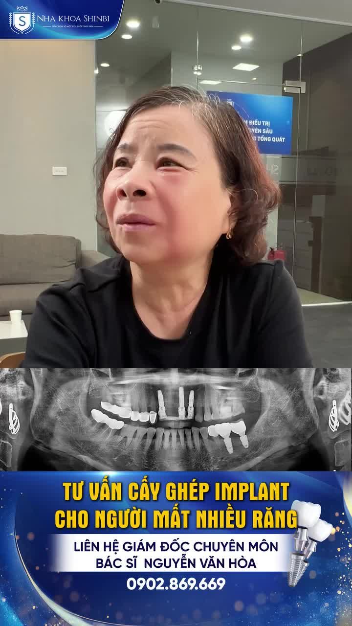 Cấy ghép implant là giải pháp hoàn hảo cho người mất nhiều răng