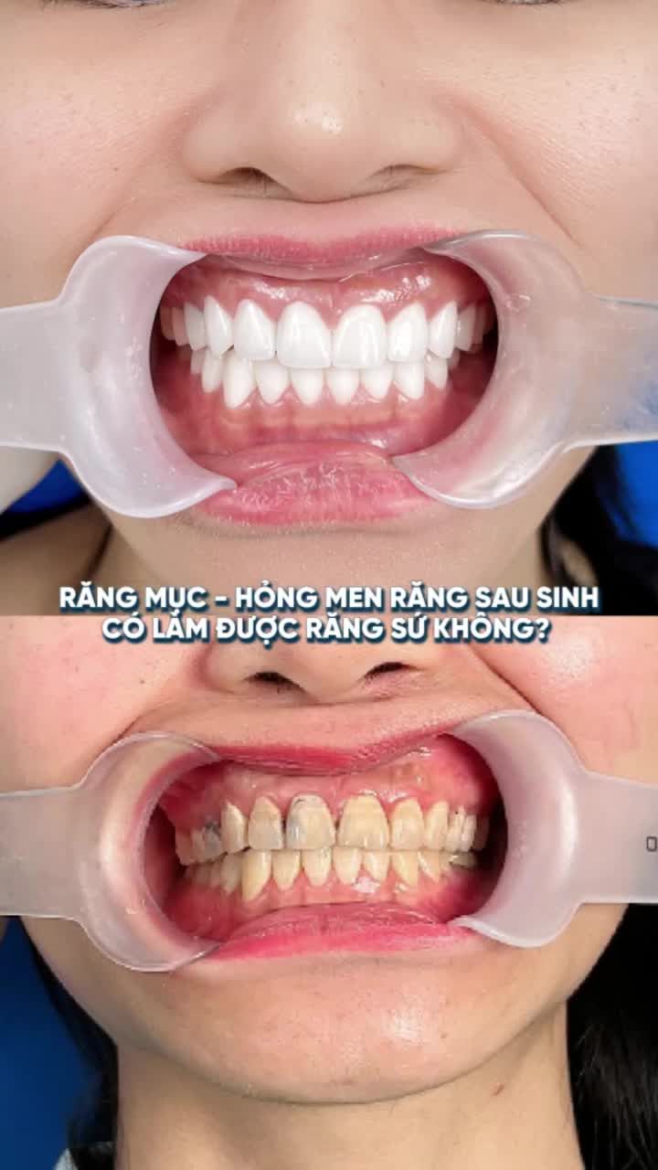 BIẾN HÓA RĂNG MỤC – HỎNG MEN THÀNH HÀM RĂNG TRẮNG SÁNG – CHẮC KHỎE VẠN NGƯỜI MÊ