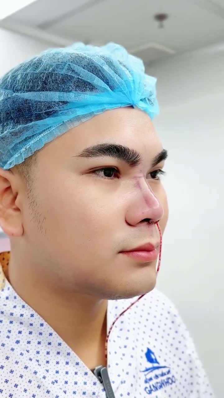 ANH H.V. LỘT XÁC VỚI NÂNG MŨI CẤU TRÚC 3D TẠI GANGWHOO – DÁNG MŨI NAM TÍNH, DIỆN MẠO ĐỈNH CAO!