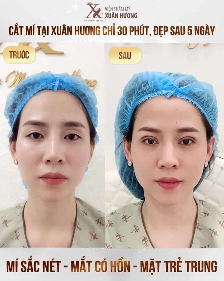 CẮT MÍ CHUẨN Y KHOA – ĐẸP TỰ NHIÊN, AN TOÀN TUYỆT ĐỐI
