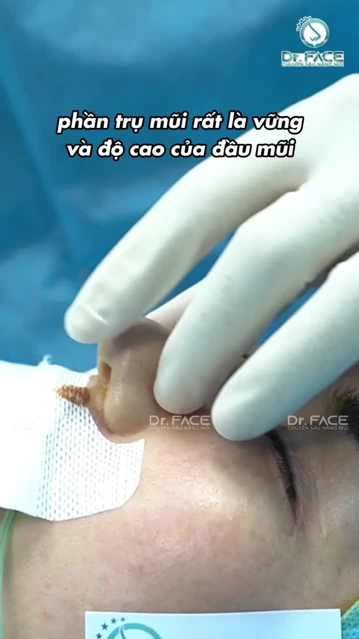 Bạn này từng nâng cấu trúc có dựng trụ nhưng không hài lòng vì thô, cứng quá.