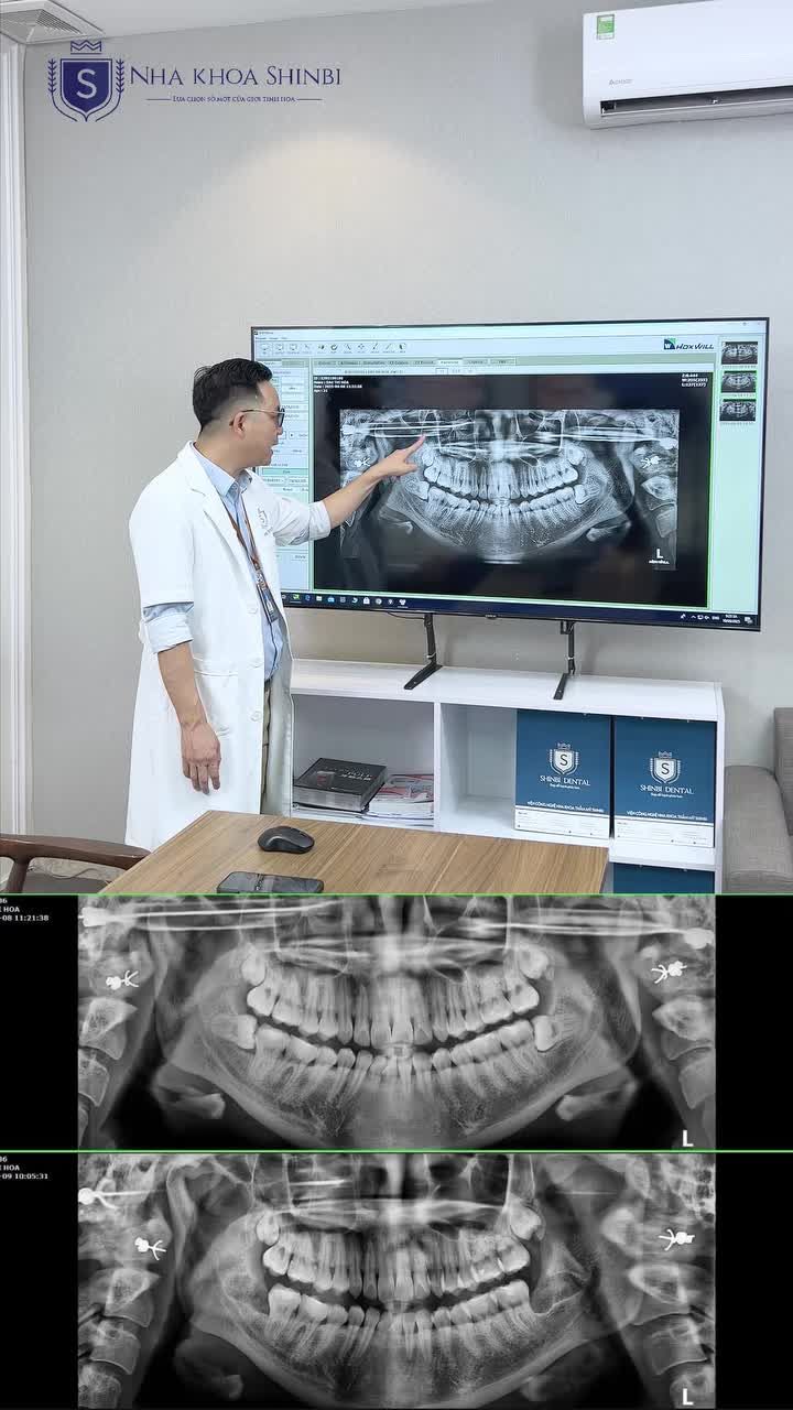 KHÔNG NHỔ RĂNG SỐ 8 – TRƯỜNG HỢP BÁC SĨ NGUYỄN VĂN HÒA CHỈ ĐỊNH