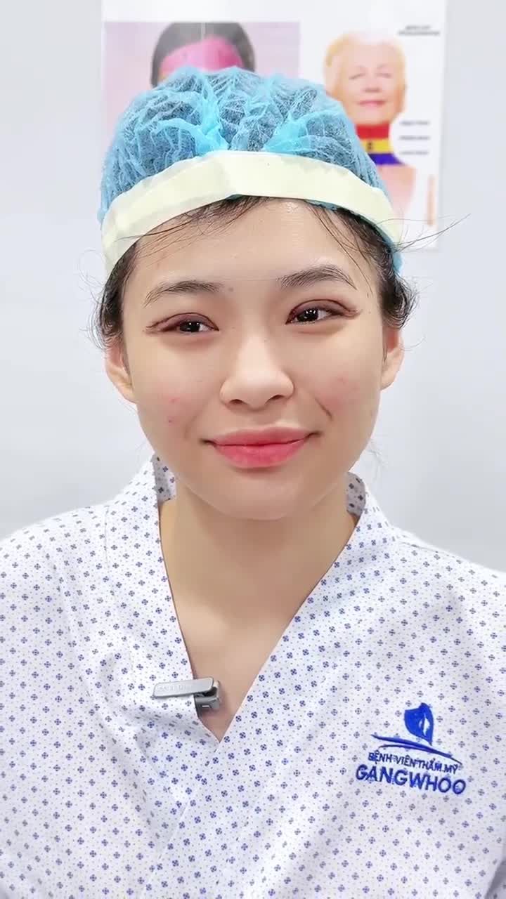 EM LINH, VIỆT KIỀU 22 TUỔI “TÓA SÁNG” NHAN SẮC SAU CẮT MÍ MẮT
