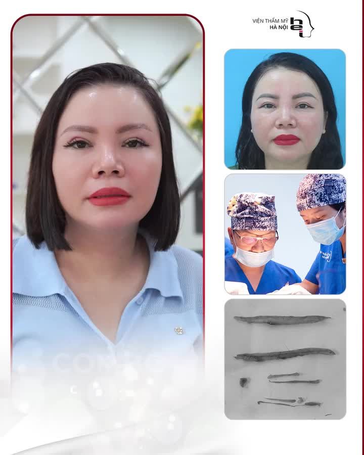 Combo trẻ hoá đôi mắt toàn diện