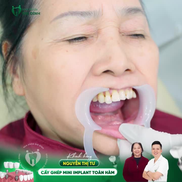 TÁI SINH NỤ CƯỜI, ĂN NGON SỐNG KHỎE NHỜ TRỒNG RĂNG IMPLANT