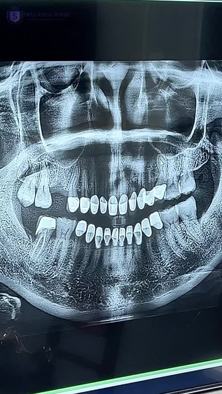 BỘ RĂNG SỨ THẨM MỸ 5 NĂM TUỔI CHỊ KHÁCH VẪN ƯNG QUÁ TRỜI ƯNG
