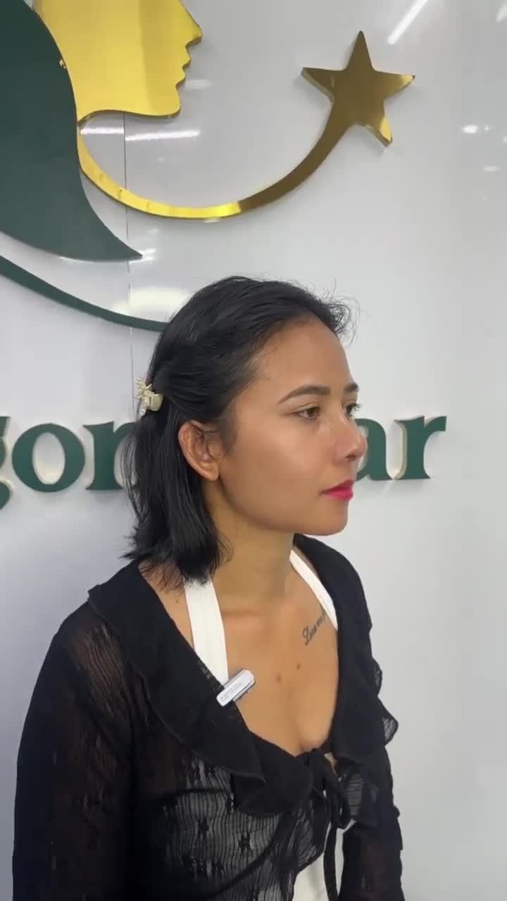 "LỘT XÁC" SAU 10 NGÀY NÂNG MŨI SUN SƯỜN CÙNG DR. HOẠT