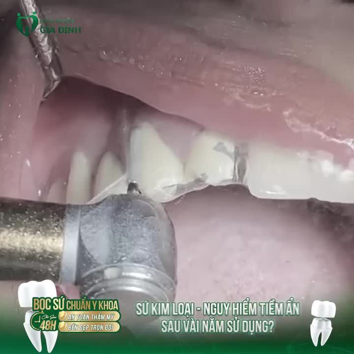 HÃY LOẠI BỎ RĂNG SỨ KIM LOẠI NẾU BẠN MUỐN CÓ HÀM RĂNG KHỎE MẠNH!