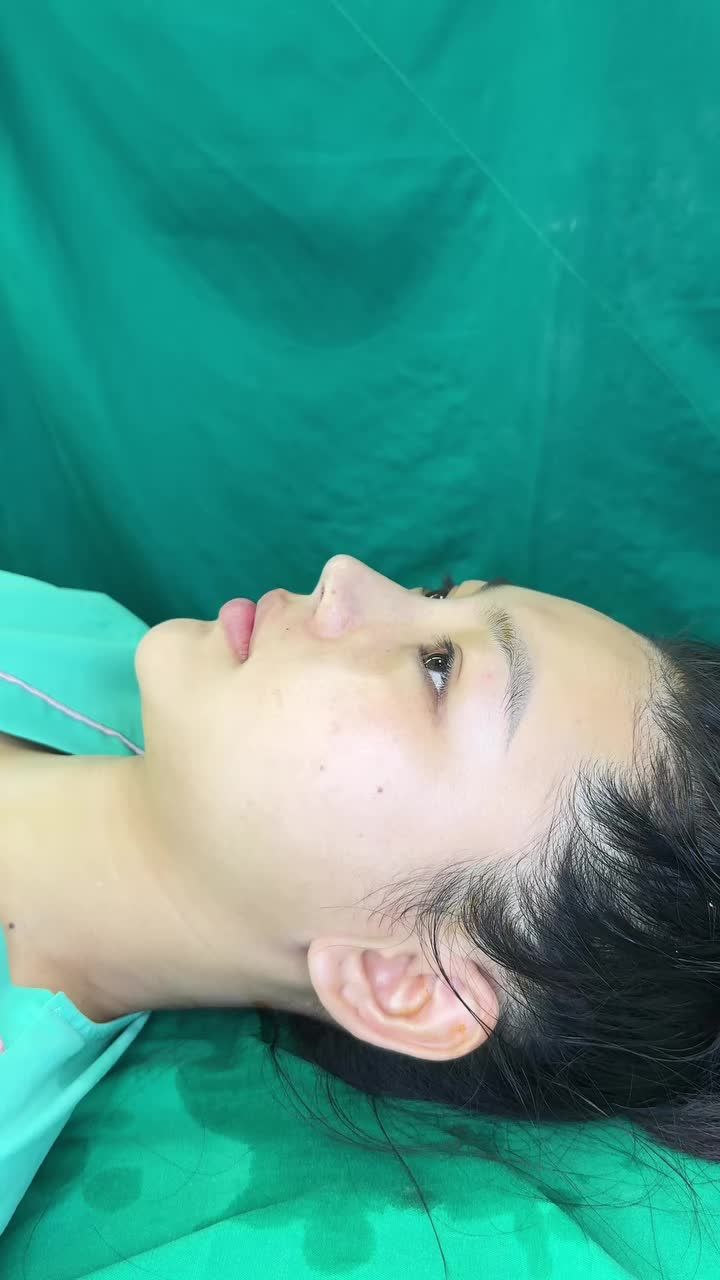 Case mũi bọc sụn vừa hoàn thành