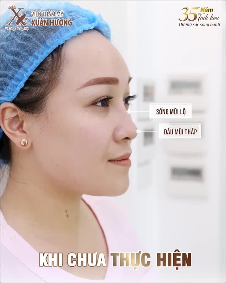 CA SĨ MINH NGỌC – 7 NĂM VẪN GIỮ DÁNG MŨI ĐẸP TỰ NHIÊN