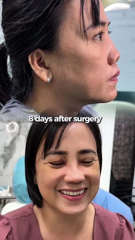 TỪ MŨI BIẾN DẠNG CO RÚT NGHIÊM TRỌNG ĐƯỢC SỬA LẠI CHỈ SAU 8 NGÀY