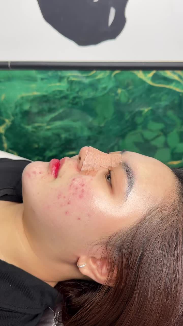Case bọc sụn được 5 ngày