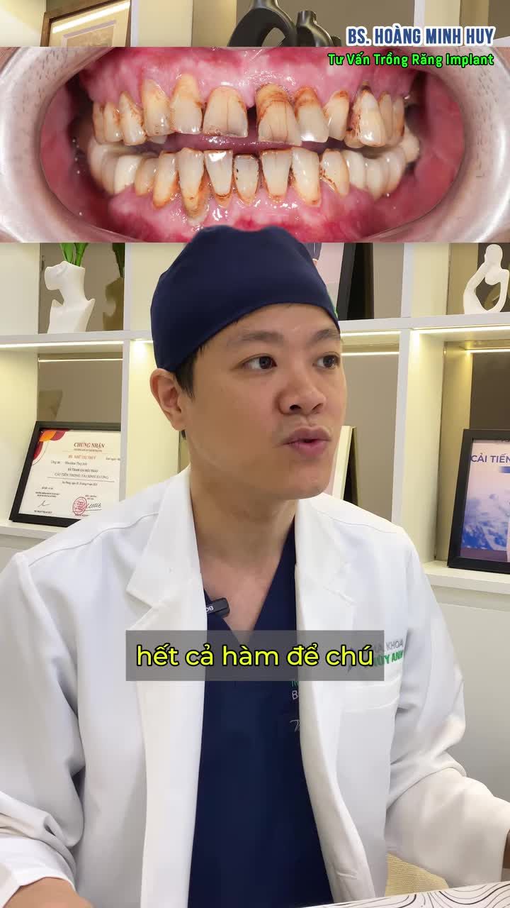 Nhổ hết răng thật để trồng toàn hàm – NÊN hay KHÔNG?