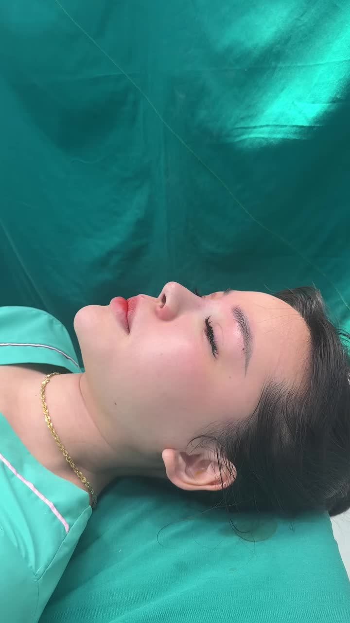 Nâng mũi bọc sụn - Case mũi thứ 5 trong ngày vừa hoàn thành - Giá chỉ 17TR - Đẹp ngay sau phẫu thuật.