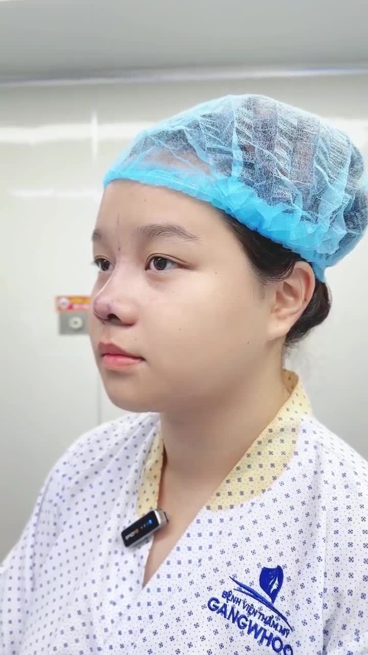 CÔ GÁI 22 TUỔI LỘT XÁC NHAN SẮC SAU 60 PHÚT NÂNG MŨI TẠI BỆNH VIỆN THẨM MỸ GANGWHOO – DÁNG MŨI S-LINE, GƯƠNG MẶT TỎA SÁNG!