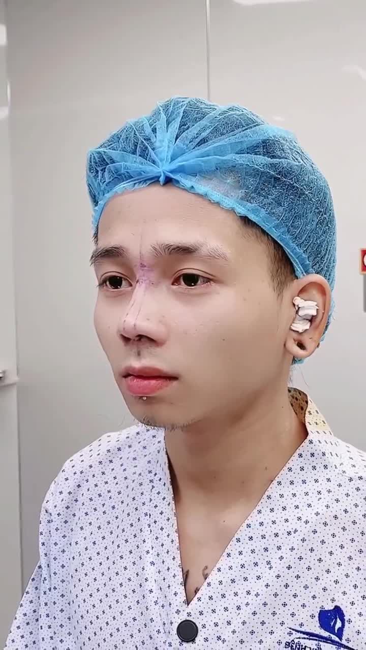 ANH H.V. LỘT XÁC VỚI NÂNG MŨI CẤU TRÚC 3D TẠI GANGWHOO – DÁNG MŨI NAM TÍNH, DIỆN MẠO ĐỈNH CAO!