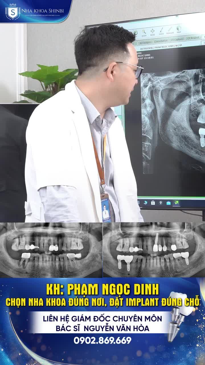 Muốn cắm một chiếc Implant tốt, đừng chỉ chọn giá mà hãy chọn: