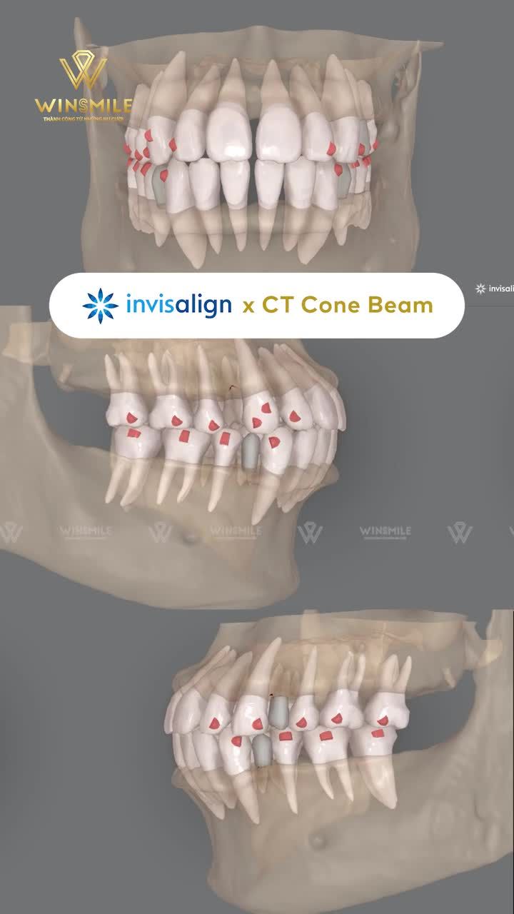 INVISALIGN x CT CONE BEAM: KẾT HỢP CÔNG NGHỆ MANG TỚI PHIÊN BẢN TIÊN TIẾN NHẤT - TỪ HÌNH ẢNH 3D BIẾN TƯƠNG LAI THÀNH HIỆN THỰC