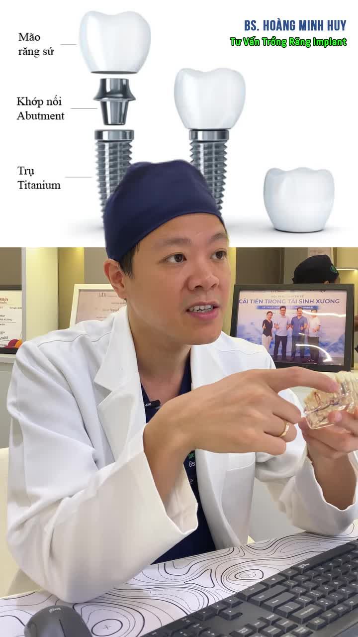 IMPLANT 1 ĐỔI 1, BẠN ĐÃ THỰC SỰ HIỂU VỀ CHẾ ĐỘ BẢO HÀNH?
