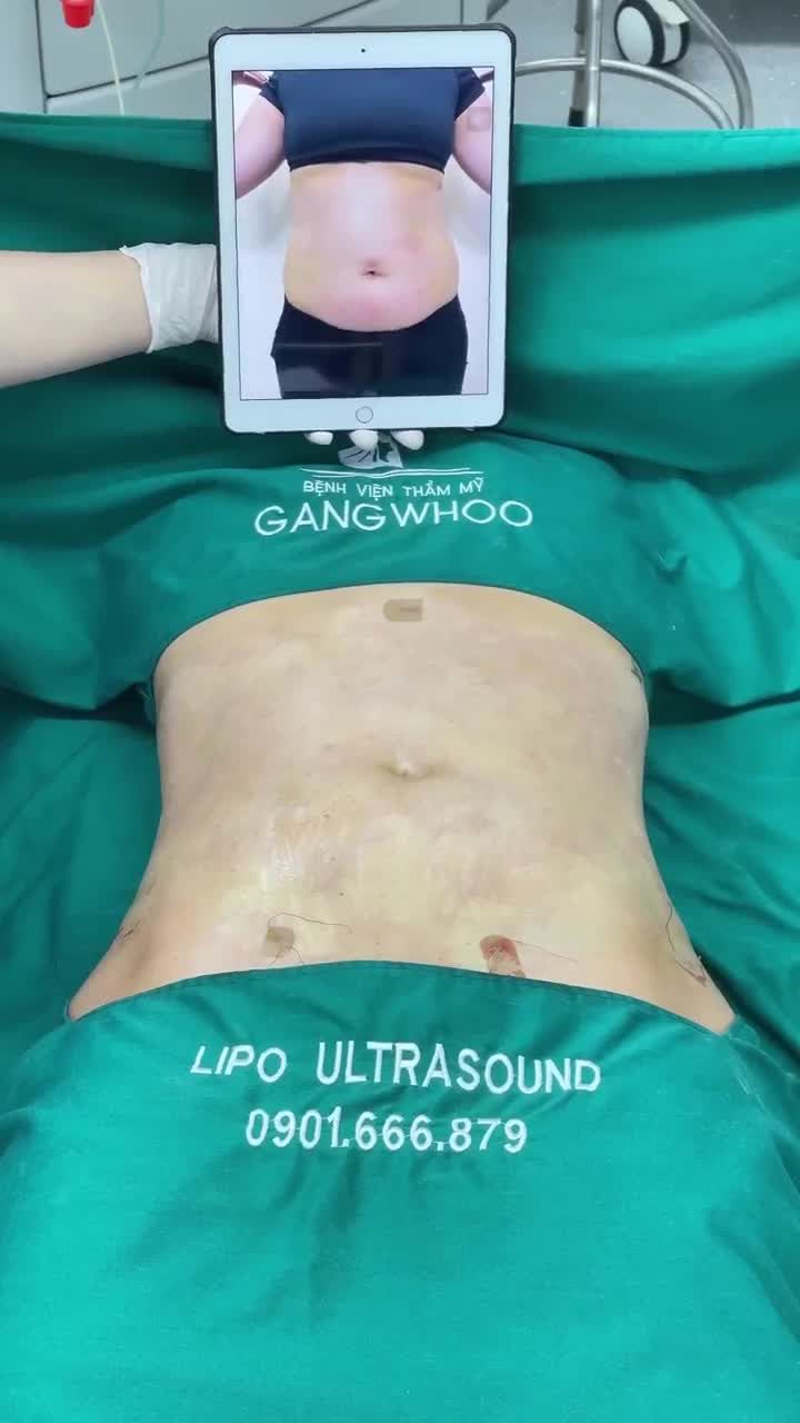 HÀNH TRÌNH LẤY LẠI VÒNG EO ĐỒNG HỒ CÁT CỦA KHÁCH HÀNG V. TẠI GANGWHOO – DÁNG BỤNG SĂN CHẮC CHỈ SAU 60 PHÚT!