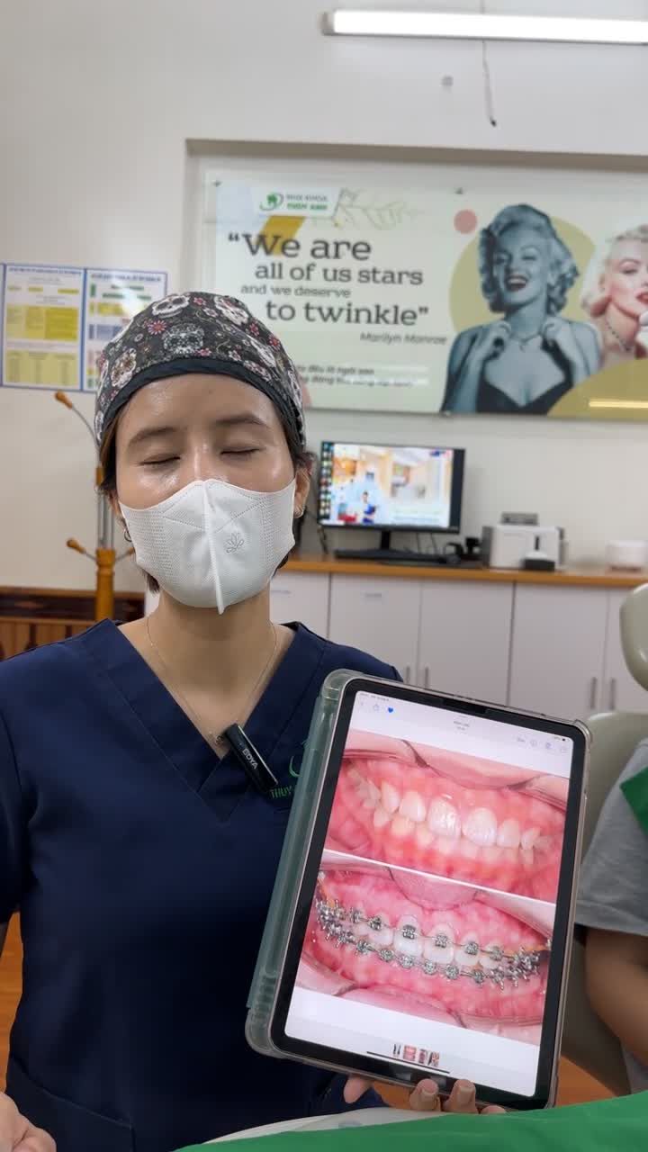 Phân tích quá trình chỉnh nha và tháo mắc cài cho bạn khách hàng gặp tình trạng răng hô, khớp cắn sâu tại Nha Khoa Thuỳ Anh