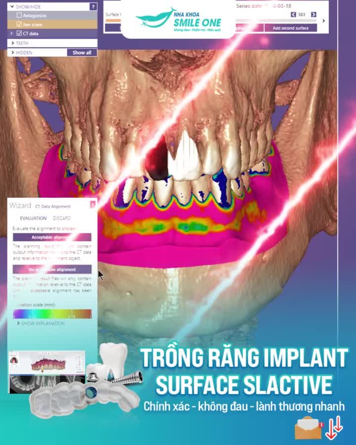 Giải pháp tối ưu cho mọi trường hợp mất răng - Không đau, lành thương nhanh tại Nha khoa Smile One!