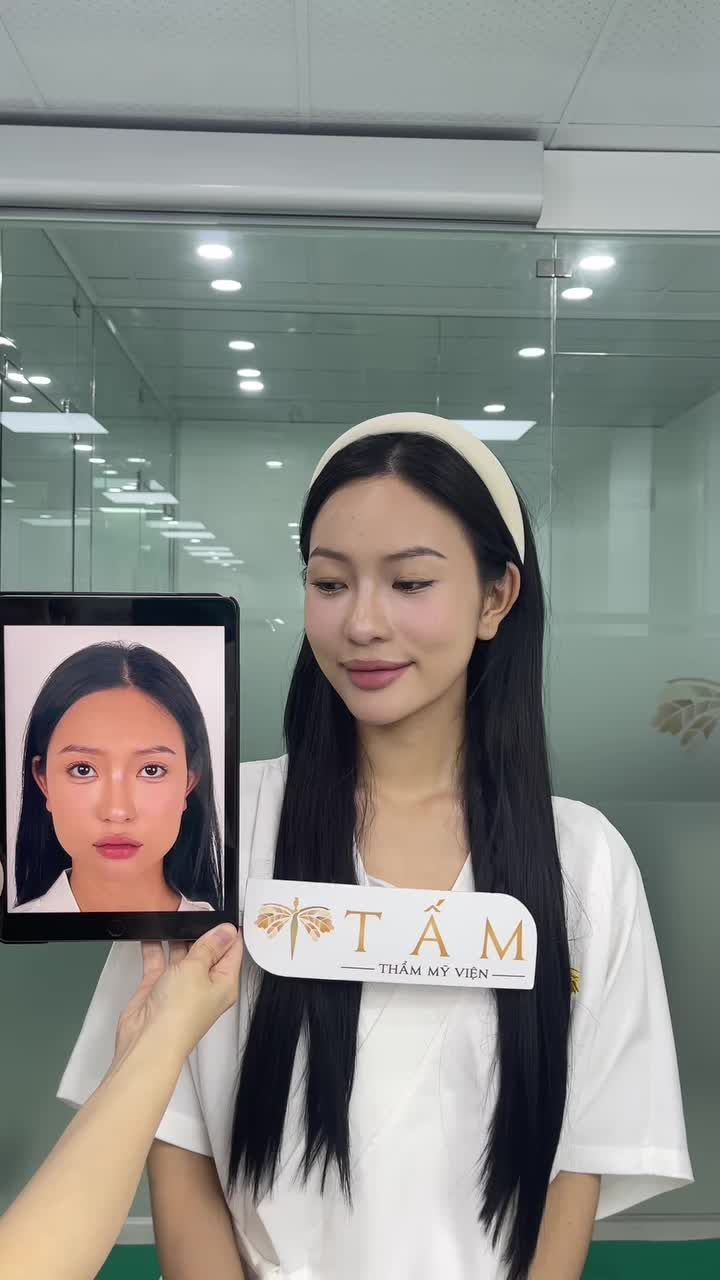 Tưởng đâu gương mặt nhỏ là chuyện không thể… sau 1 năm, Thùy Trang quay lại Phòng Khám để tái khám