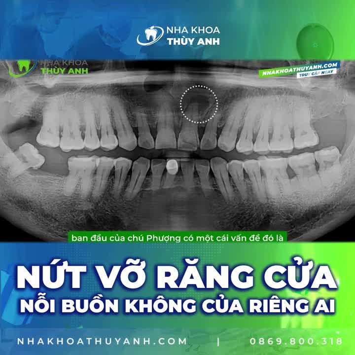RĂNG CỬA NỨT GÃY ĐƯỢC LÀM LẠI ĐẸP CHẮC GIÚP CHÚ PHƯỢNG TỰ TIN TRỞ LẠI