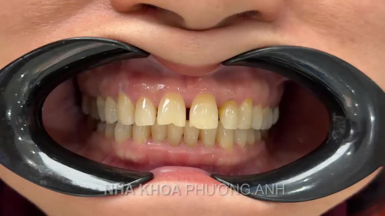 Trước đây, mỗi lần cười tôi đều vội vàng đưa tay che miệng. Hàm răng xỉn màu, khấp khểnh khiến tôi không dám mỉm cười tự nhiên. Giao tiếp với đồng nghiệp, gặp gỡ khách hàng… tôi luôn thấy mình kém tự tin hơn mọi người.