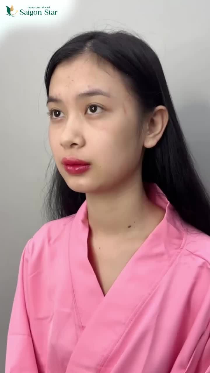 EM GÁI GENZ XINH TƯƠI - TỰ TIN SAU 10 NGÀY NÂNG MŨI CẤU TRÚC CÙNG DR. HOẠT