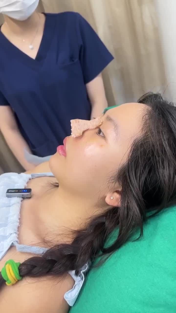 CẬN CẢNH THÁO NẸP MŨI + CẮT CHỊ CẰM SAU 10 NGÀY PHẪU THUẬT