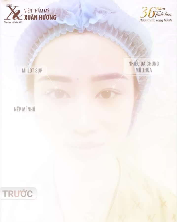 Thay Đổi Cả Diện Mạo Chỉ Sau 30 Phút Cắt Mí Tại VTM Xuân Hương