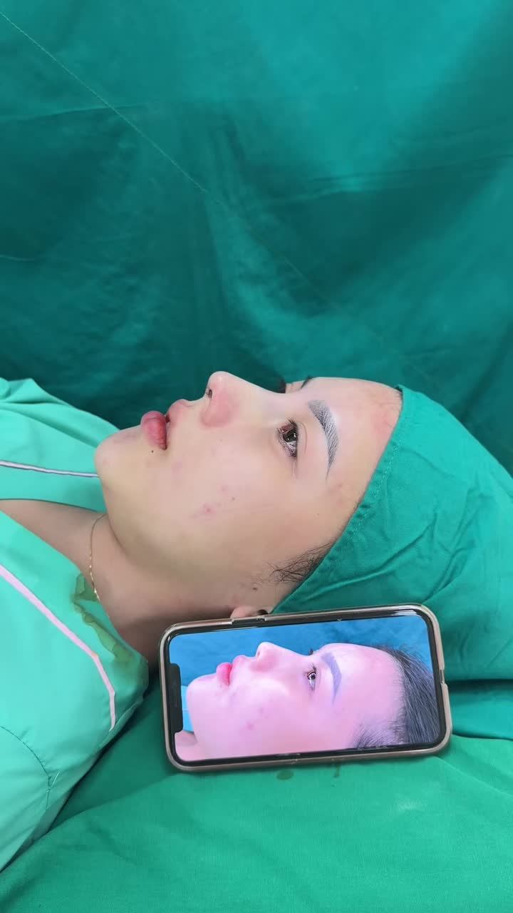 Case mũi cấu trúc vừa hoàn thành!!