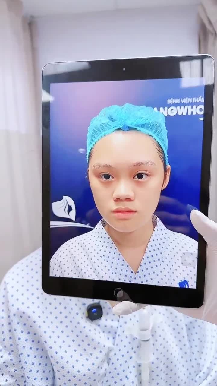 CÔ GÁI 26 TUỔI LÊN ĐỜI NHAN SẮC SAU 60 PHÚT NÂNG MŨI TẠI BỆNH VIỆN THẨM MỸ GANGWHOO – DÁNG MŨI L-LINE, GƯƠNG MẶT SẮC SẢO!