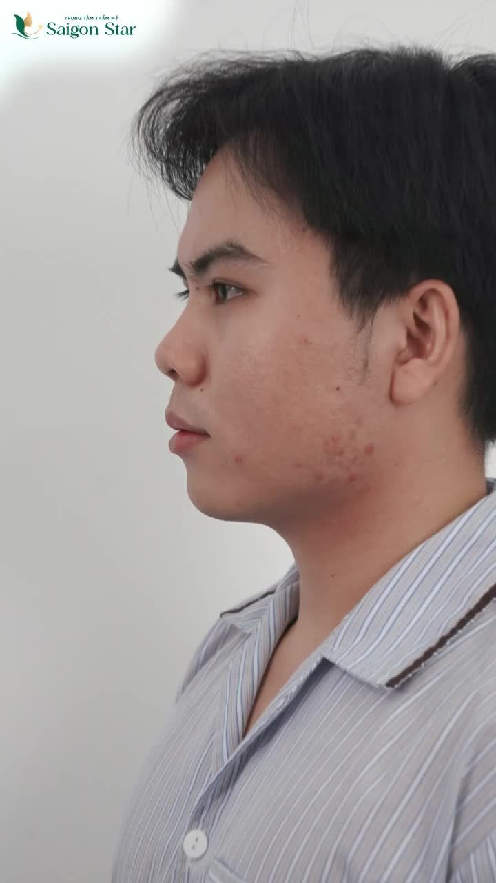 HÀNH TRÌNH LỘT XÁC DÁNG MŨI CỦA BÁC SĨ NGOẠI KHOA - KHÁCH HÀNG MAY MẮN TRÚNG GIẢI NÂNG MŨI CẤU TRÚC TẠI HỘI THẢO THẨM MỸ