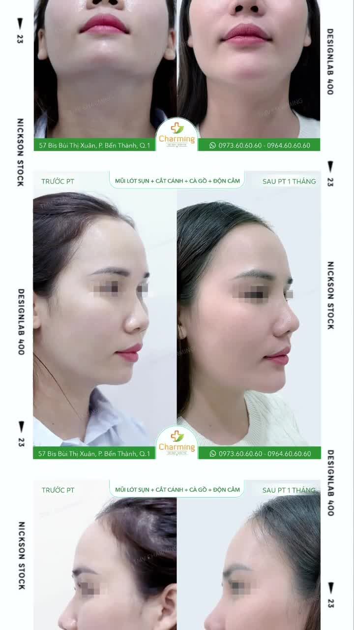 Phẫu thuật nâng mũi lót sụn kết hợp độn cằm và xử lý khuyết điểm đã mang lại cho nàng khách nét đẹp hài hòa, trẻ trung và tự tin hơn trong từng góc nhìn.