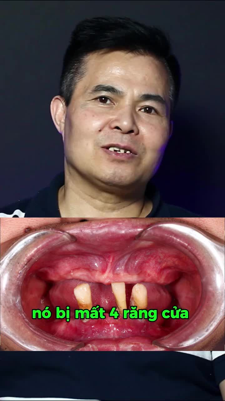 LOẠI BỎ HÀM THÁO LẮP, TRỒNG IMPLANT CỐ ĐỊNH TOÀN HÀM ĐỂ ĐƯỢC ĂN NGON, SỐNG KHOẺ Ở TUỔI TRUNG NIÊN