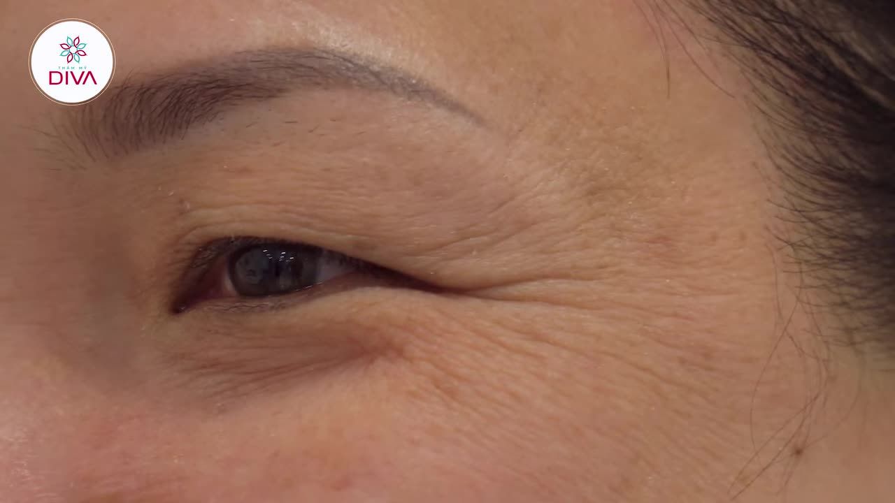 CẮT MÍ MẮT - GIẢI PHÁP "VÀNG" CHO TÌNH TRẠNG MÍ SỤP, MÍ LÓT, MẮT MỘT MÍ