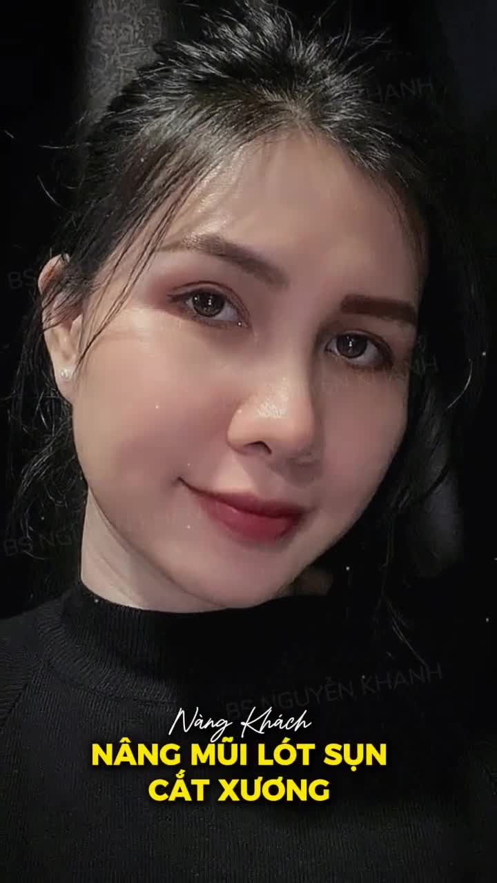 Chiếc mũi sau khi lót sụn kết hợp cắt xương không chỉ thay đổi dáng mũi, mà còn làm gương mặt thanh thoát và sang hẳn lên.