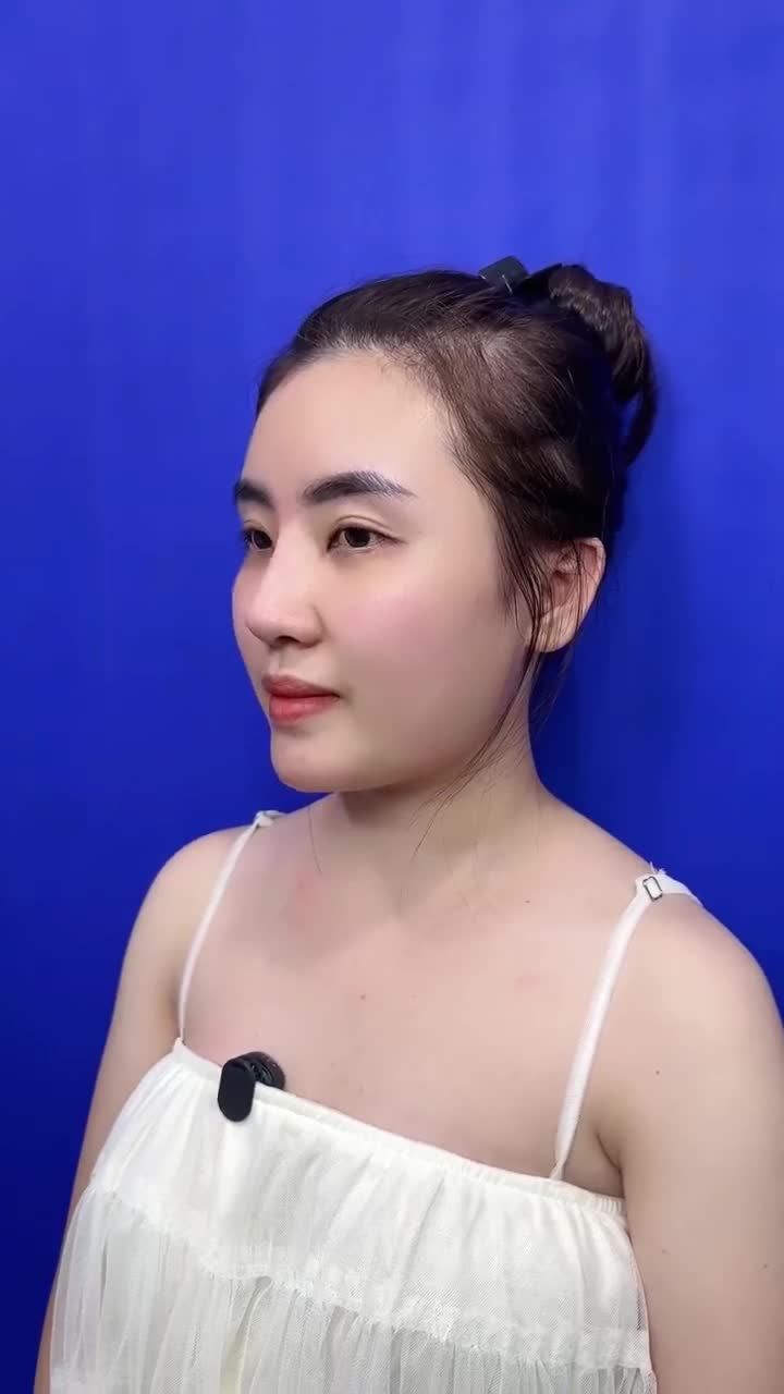 CHỊ KHÁCH HÀNG LỘT XÁC DIỆN MẠO SAU 1 THÁNG NÂNG MŨI TẠI BỆNH VIỆN THẨM MỸ GANGWHOO – DÁNG MŨI HOÀN HẢO, TỰ TIN TỎA SÁNG!