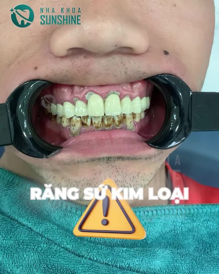 SỰ THẬT ĐẰNG SAU RĂNG SỨ KIM LOẠI BẠN ĐÃ BIẾT CHƯA?