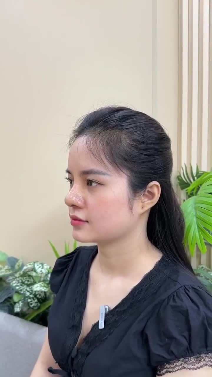 CHIA SẺ CẢM NHẬN KHI ĐI NÂNG MŨI THEO REVIEW CỦA HOT TIKTOKER