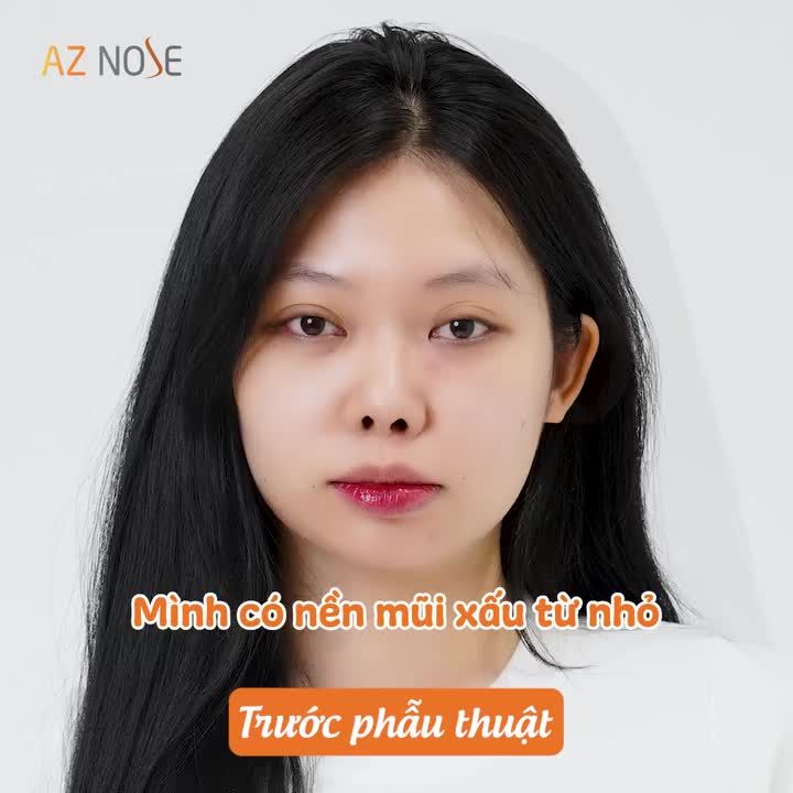 Trình dược viên 2K và hành trình tìm lại tự tin sau lần nâng mũi hỏng