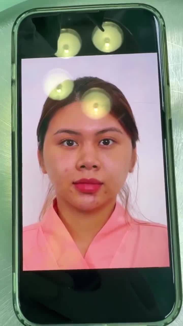 KẾT QUẢ NÂNG MŨI SỤN SƯỜN - SỬA LẠI MŨI HỎNG