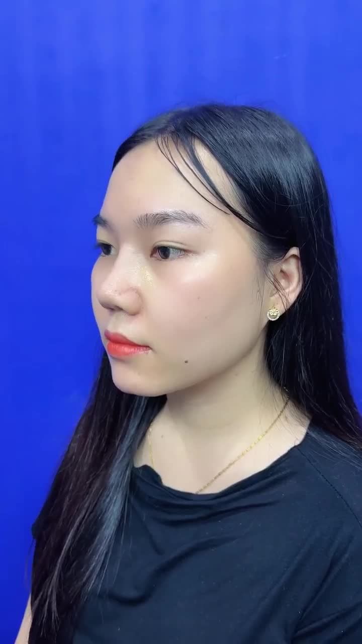 HÀNH TRÌNH LỘT XÁC VỚI NÂNG MŨI CẤU TRÚC 3D CỦA CHỊ T.A. TẠI GANGWHOO – DÁNG MŨI THANH TÚ, DIỆN MẠO RẠNG NGỜI Ở TUỔI 27!