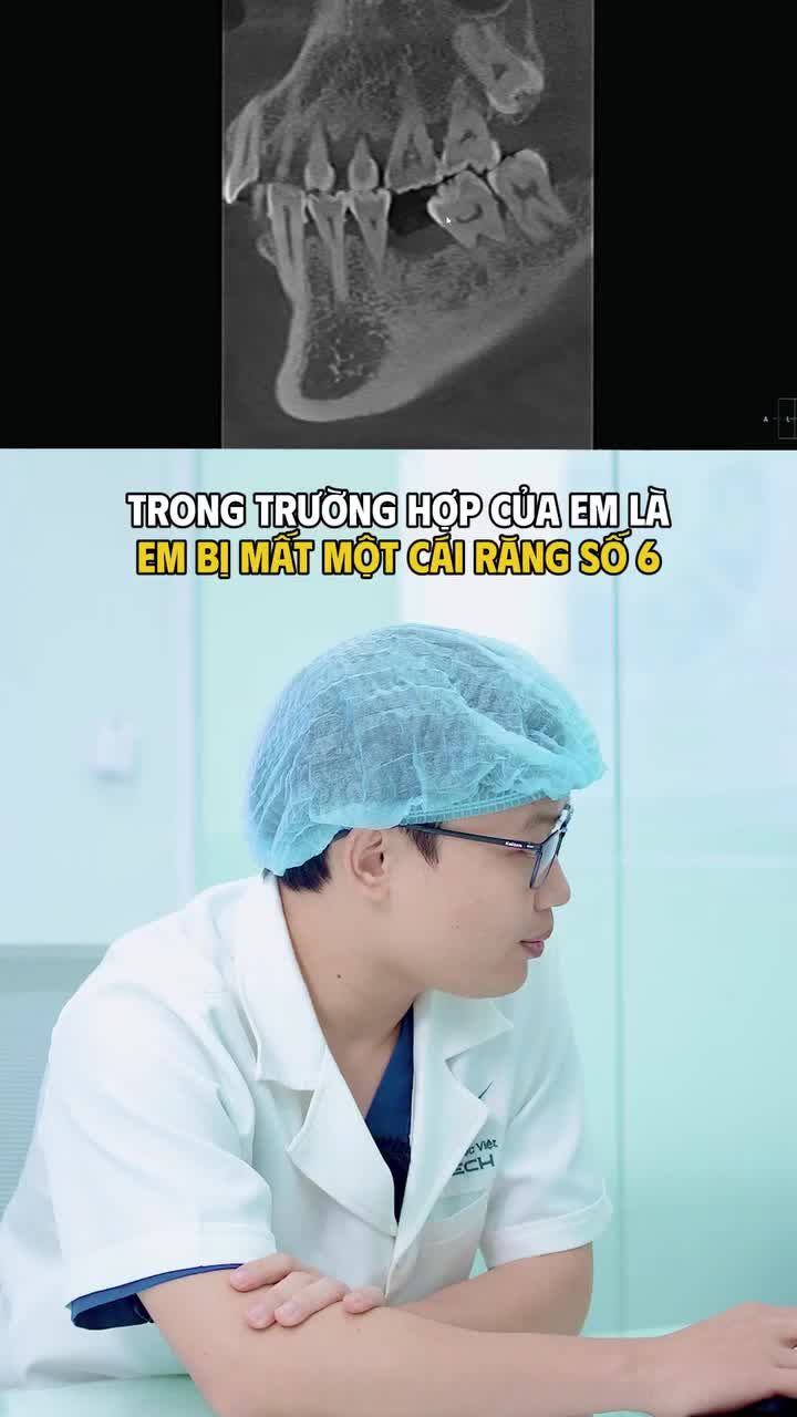 Mất răng 6 không trồng lại có sao không?