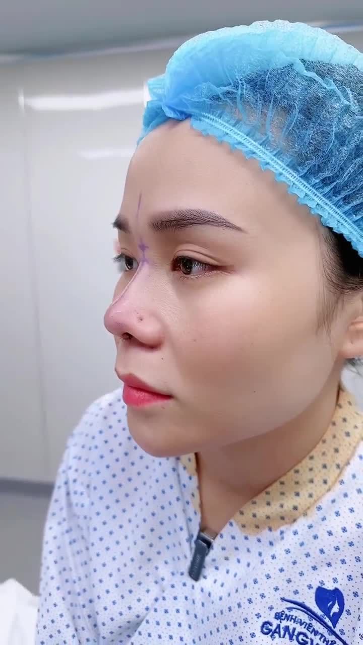 CHỊ KHÁCH HÀNG LỘT XÁC NHAN SẮC SAU 60 PHÚT NÂNG MŨI BỌC SỤN TẠI BỆNH VIỆN THẨM MỸ GANGWHOO – DÁNG MŨI THANH TÚ, GƯƠNG MẶT HÀI HÒA!