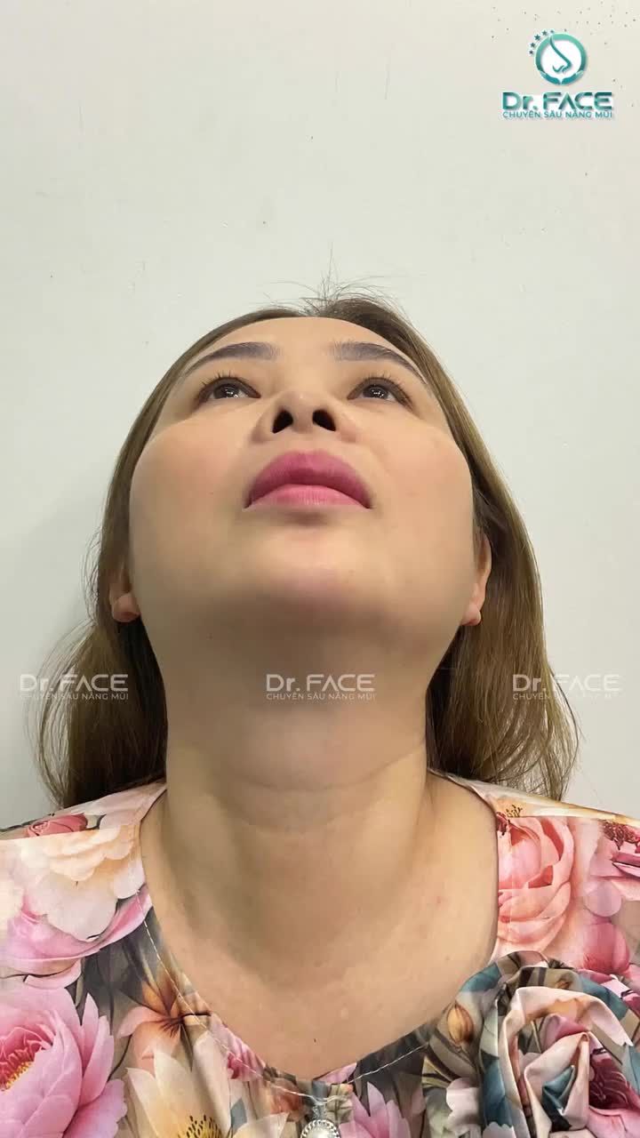 NÂNG MŨI CỠ NÀO LÀ VỪA?