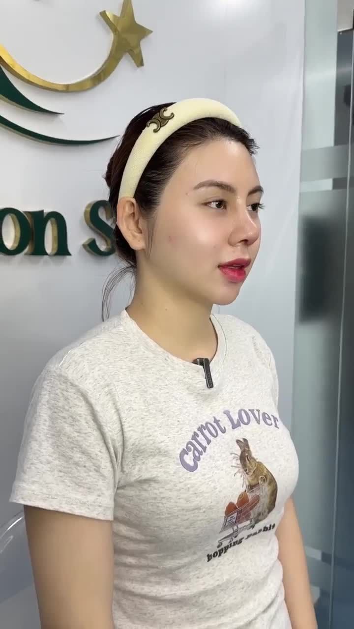 KẾT QUẢ SAU 10 NGÀY NÂNG MŨI SỤN SƯỜN SỬA LẠI MŨI HỎNG KH. TRÚC TIÊN